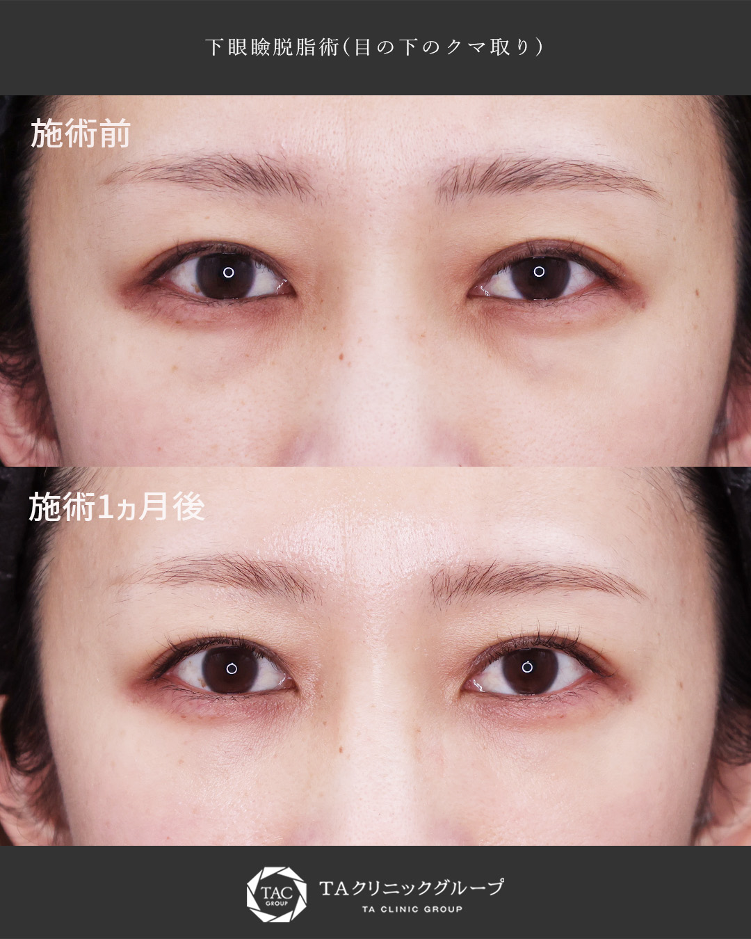下眼瞼脱脂術（目の下のたるみ取り・目の下の脂肪ふくらみ取り）の症例写真 施術前後 