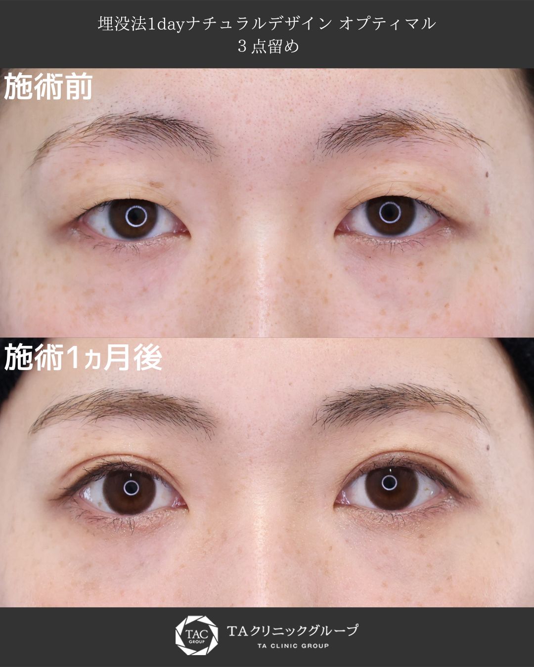 二重埋没法の症例写真 施術前後 
