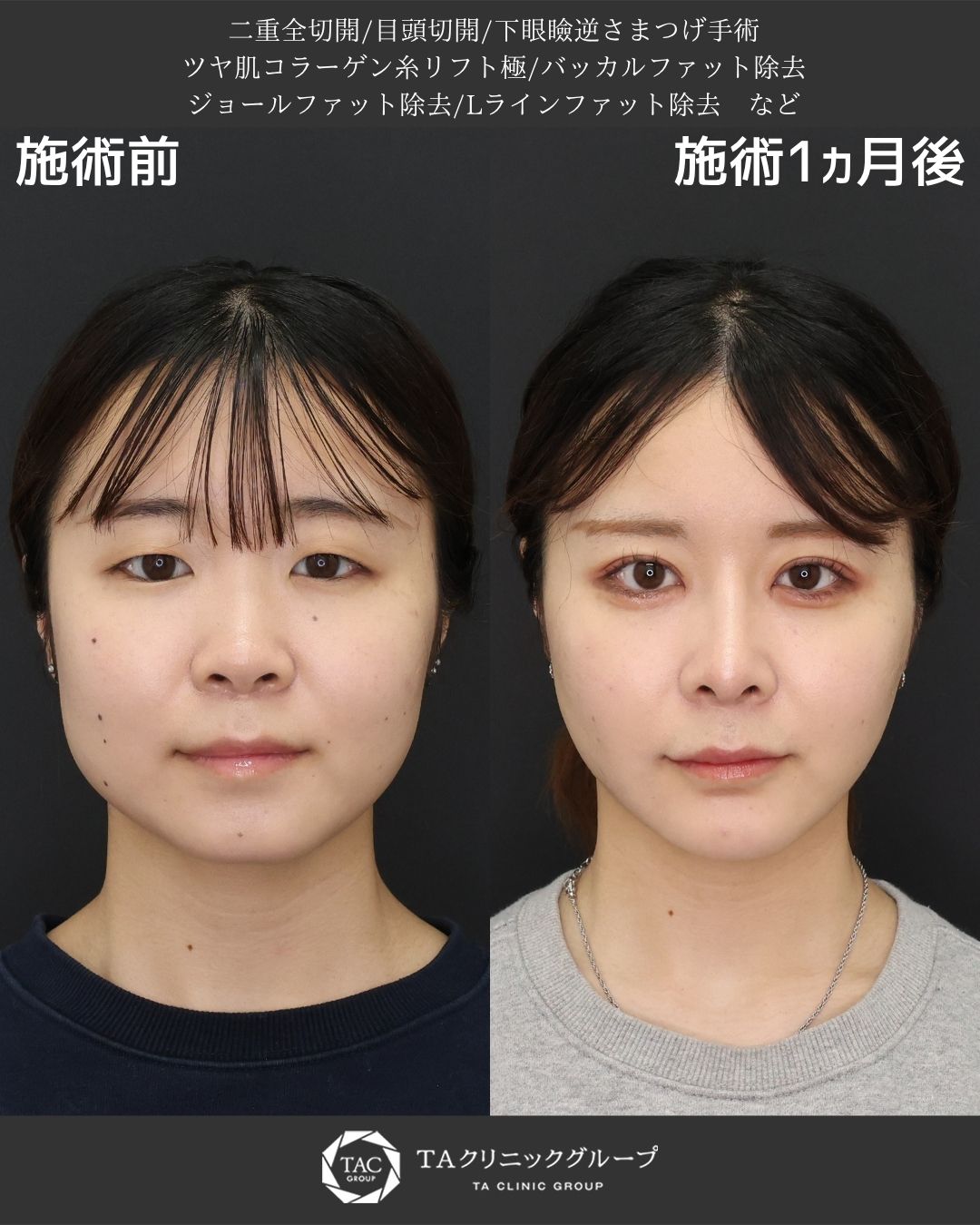 二重切開（全切開法）/目頭切開術/TAC式 ツヤ肌コラーゲンリフト®の症例写真 施術前後 