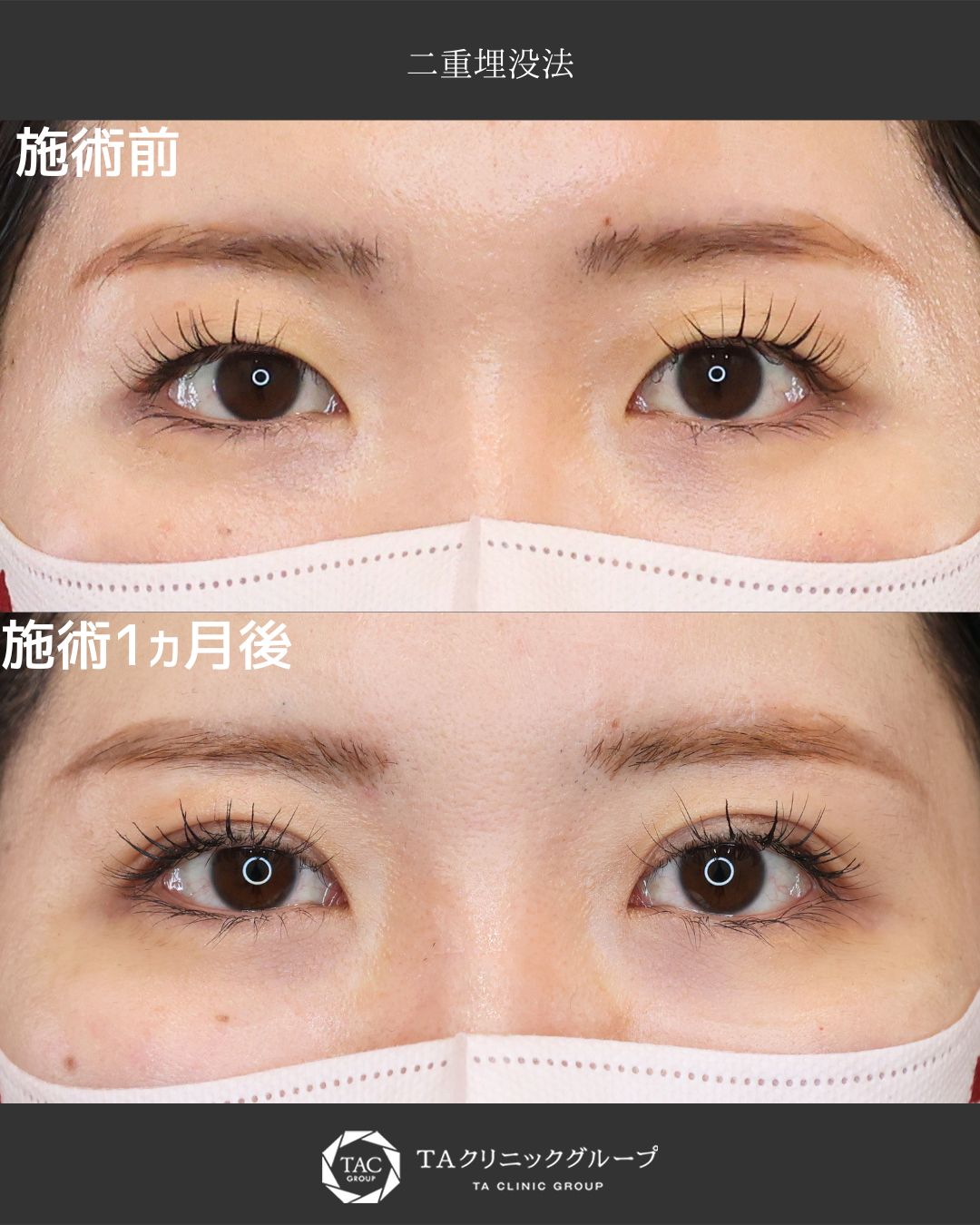 二重埋没法の症例写真 施術前後 