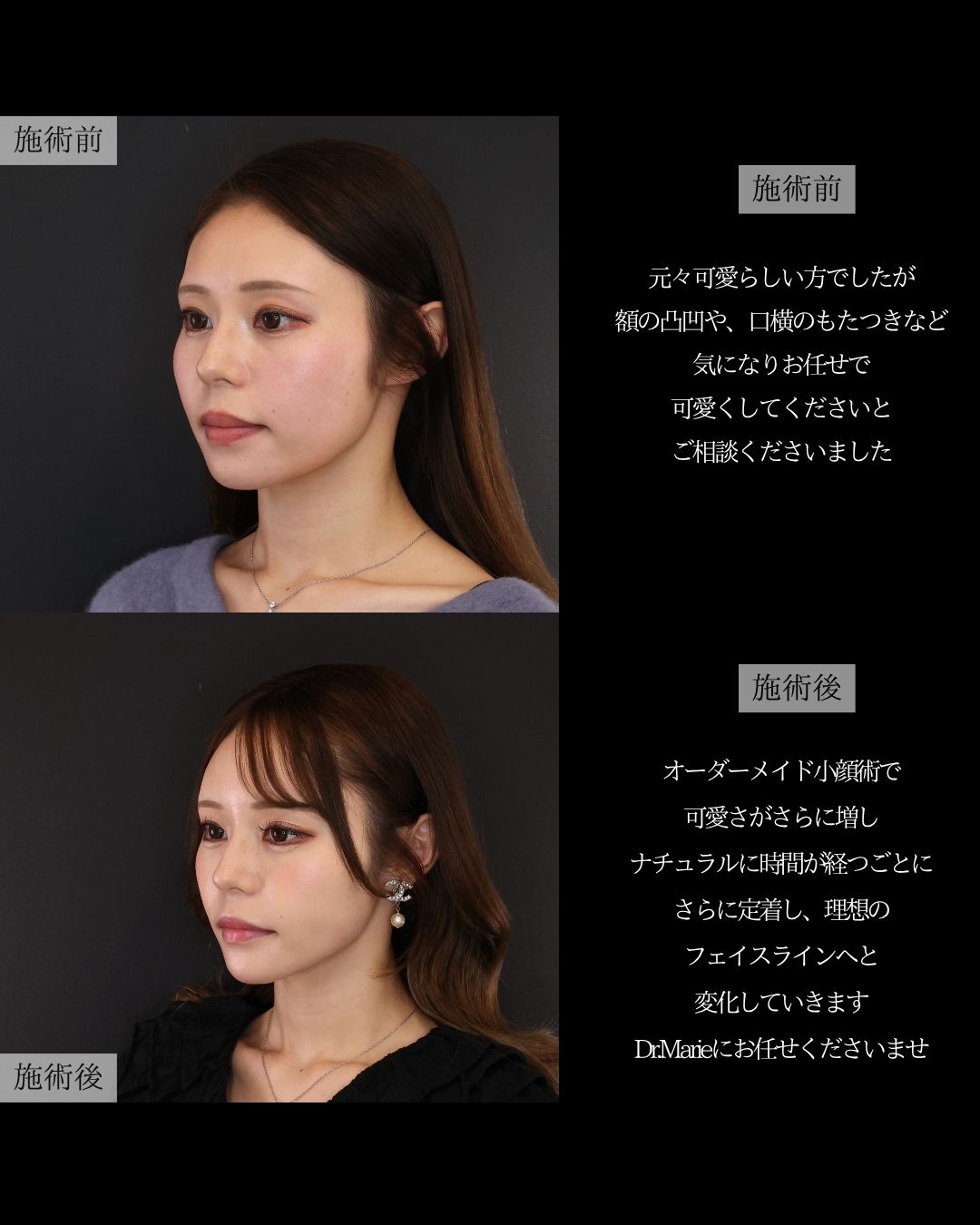 ジョールファット除去/エラボトックス注射/顎下の脂肪吸引の症例写真 施術前後 