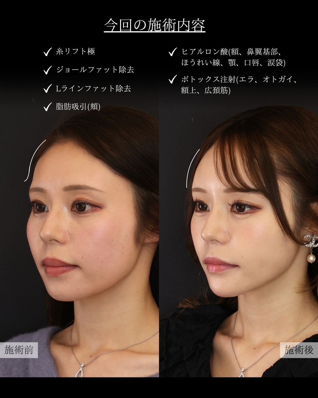 ジョールファット除去/エラボトックス注射/顎下の脂肪吸引の症例写真 施術前後 