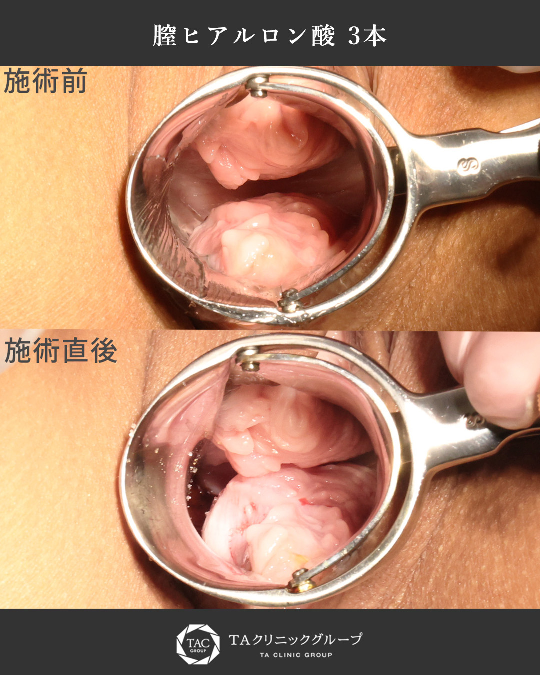 膣縮小術/Gショット不感症改善･膣感度アップ術/膣ハイフ（ヴィーナスハイフ）で膣圧向上の症例写真 施術前後 