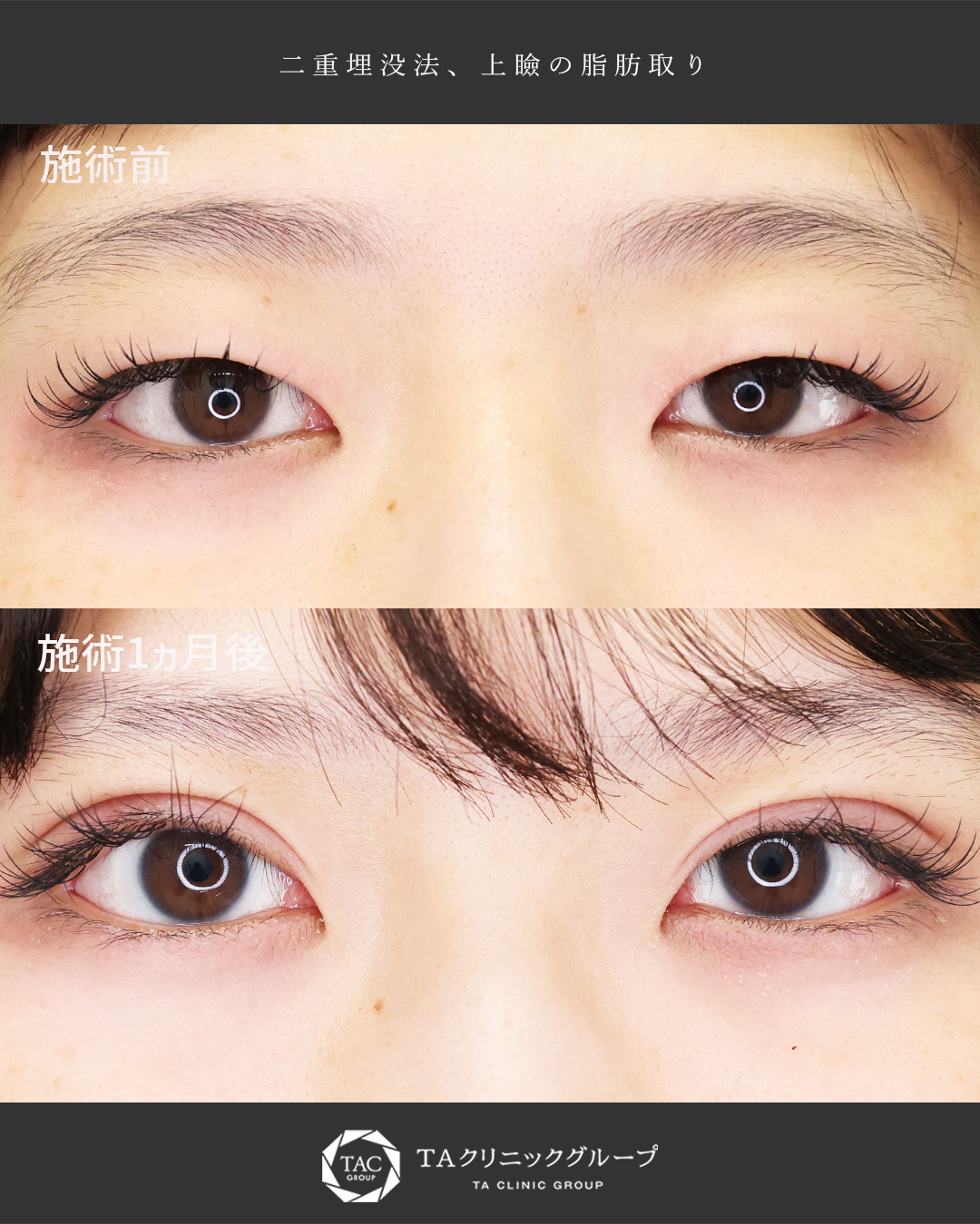二重埋没法の症例写真 施術前後 
