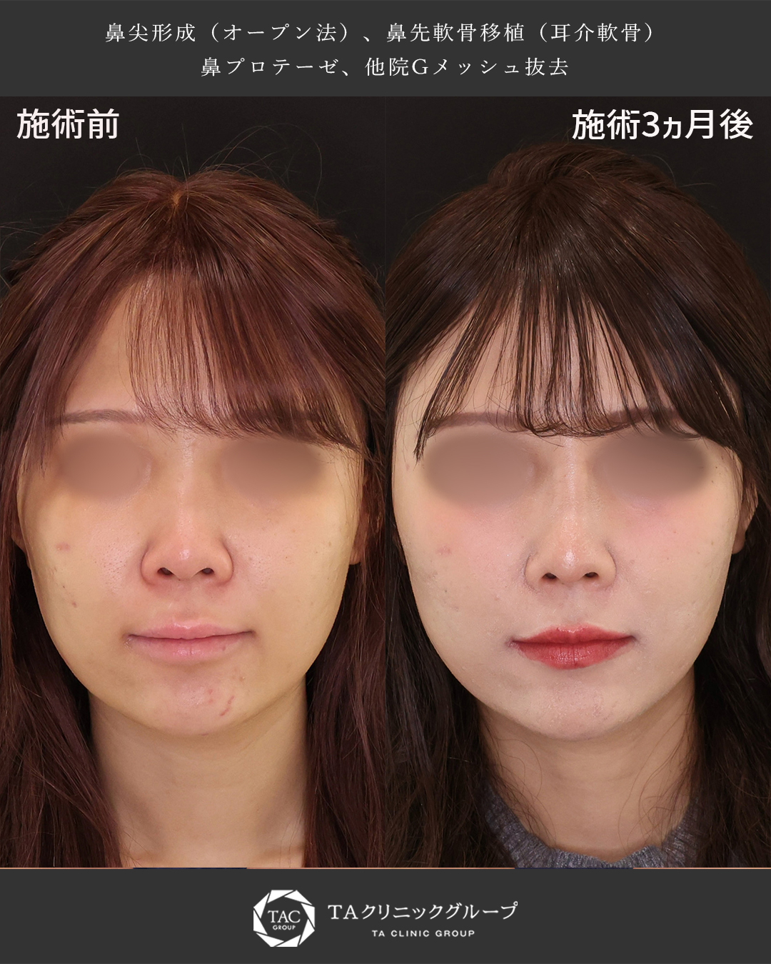 鼻尖形成・鼻尖縮小/隆鼻術（プロテーゼ・自家組織）の症例写真 施術前後 