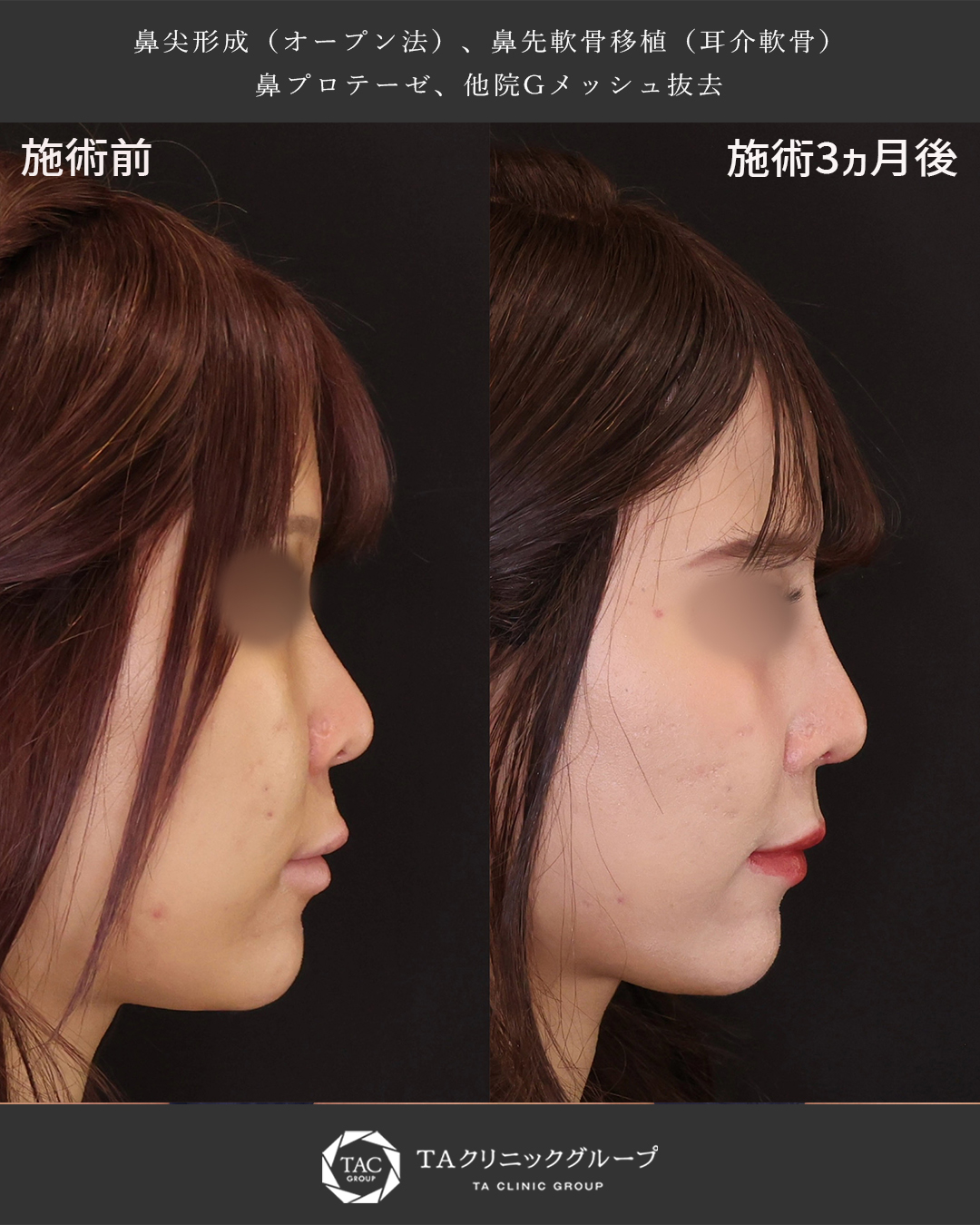 鼻尖形成・鼻尖縮小/隆鼻術（プロテーゼ・自家組織）の症例写真 施術前後 