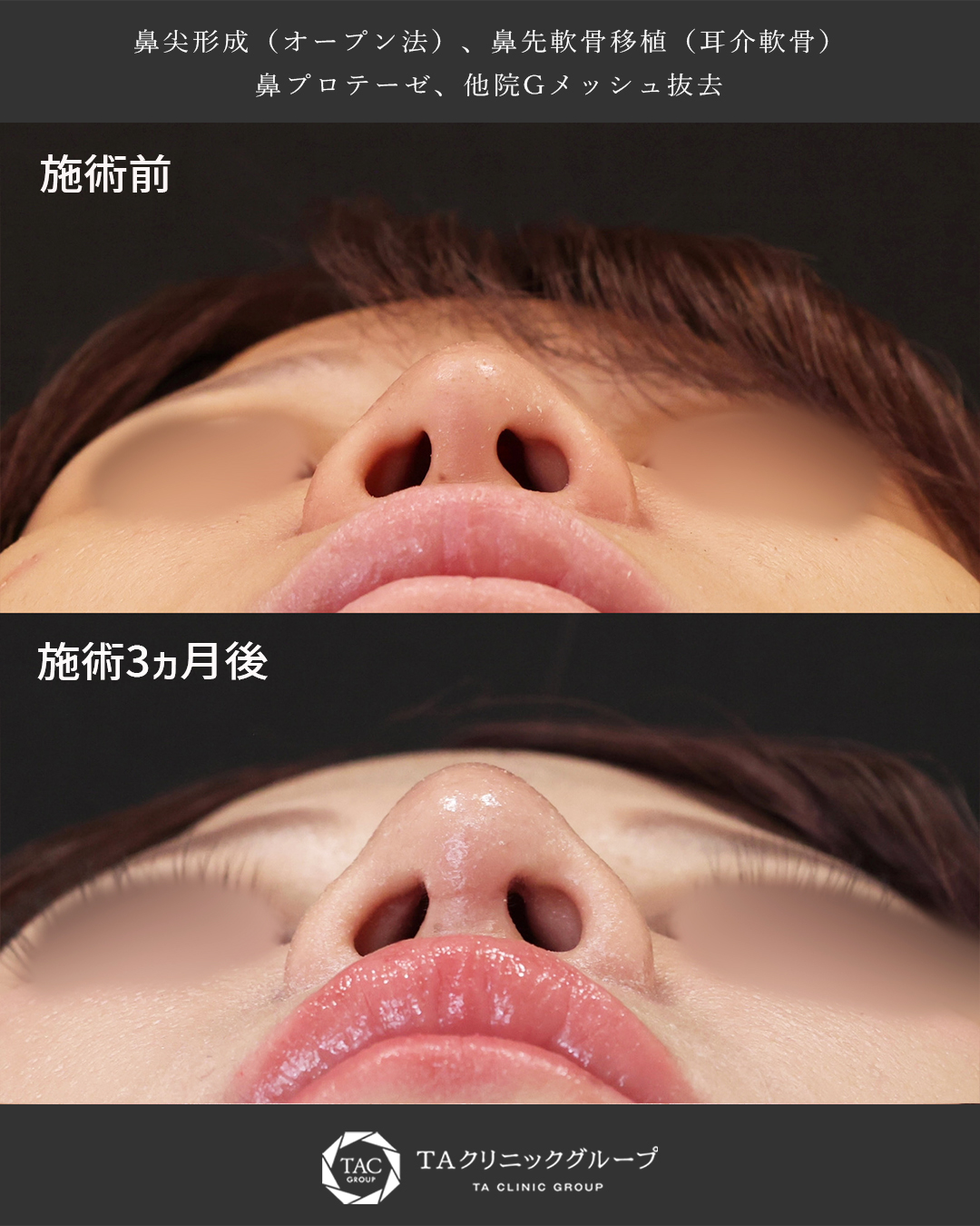 鼻尖形成・鼻尖縮小/隆鼻術（プロテーゼ・自家組織）の症例写真 施術前後 