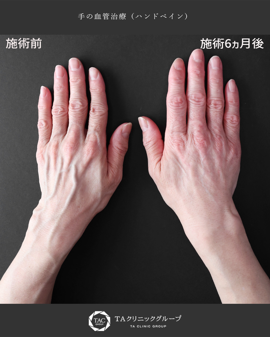 ハンドベイン（手のアンチエイジング・血管治療）の症例写真 施術前後 