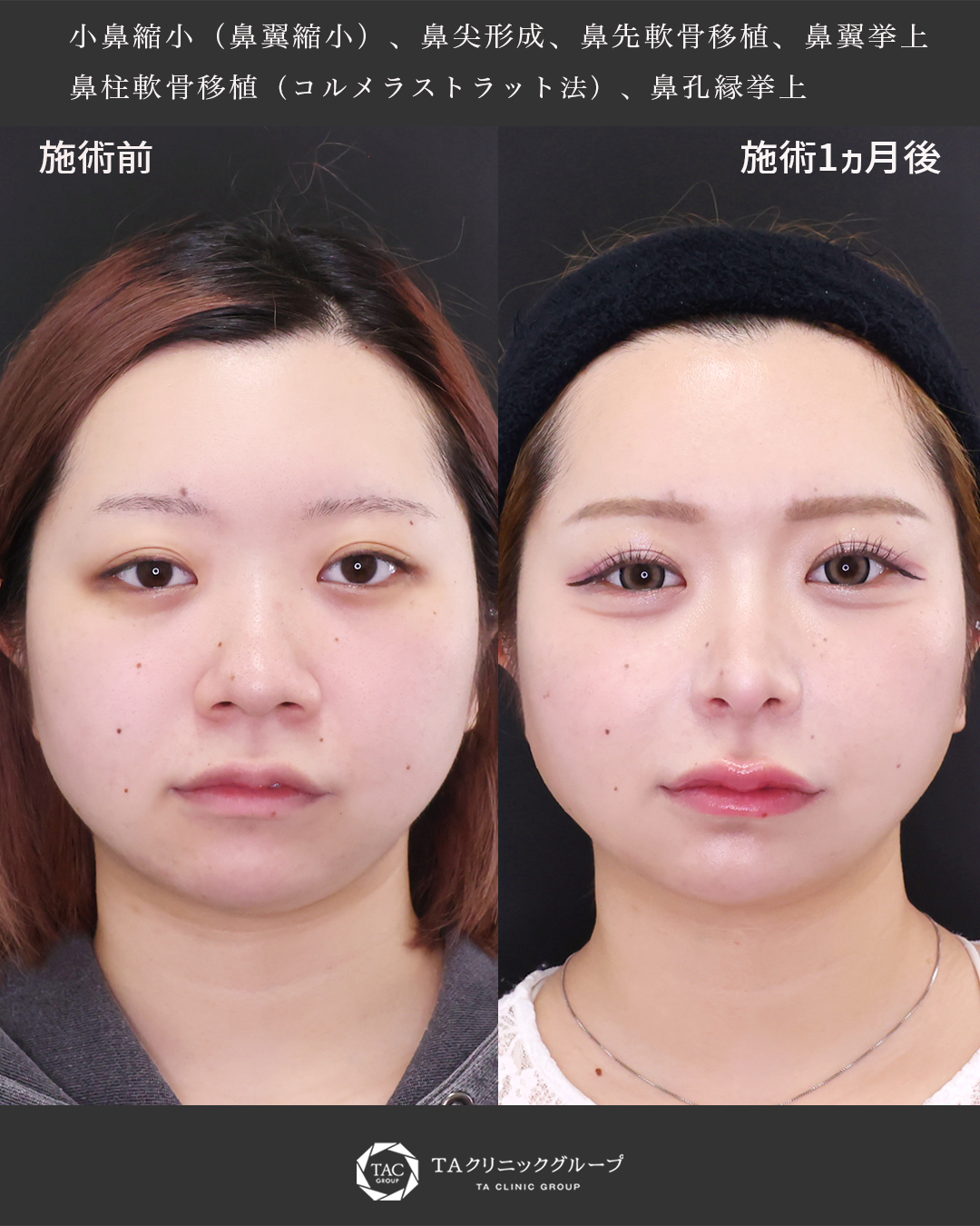 鼻尖形成・鼻尖縮小/鼻先軟骨移植/鼻翼挙上術の症例写真 施術前後 