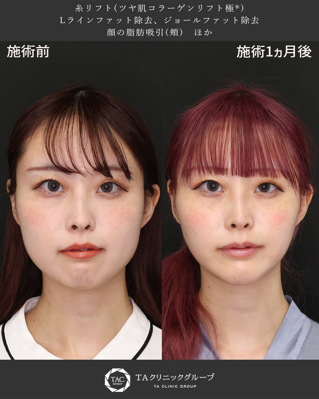 TAC式 ツヤ肌コラーゲンリフト®/顎下の脂肪吸引/ジョールファット除去の症例写真 施術前後 