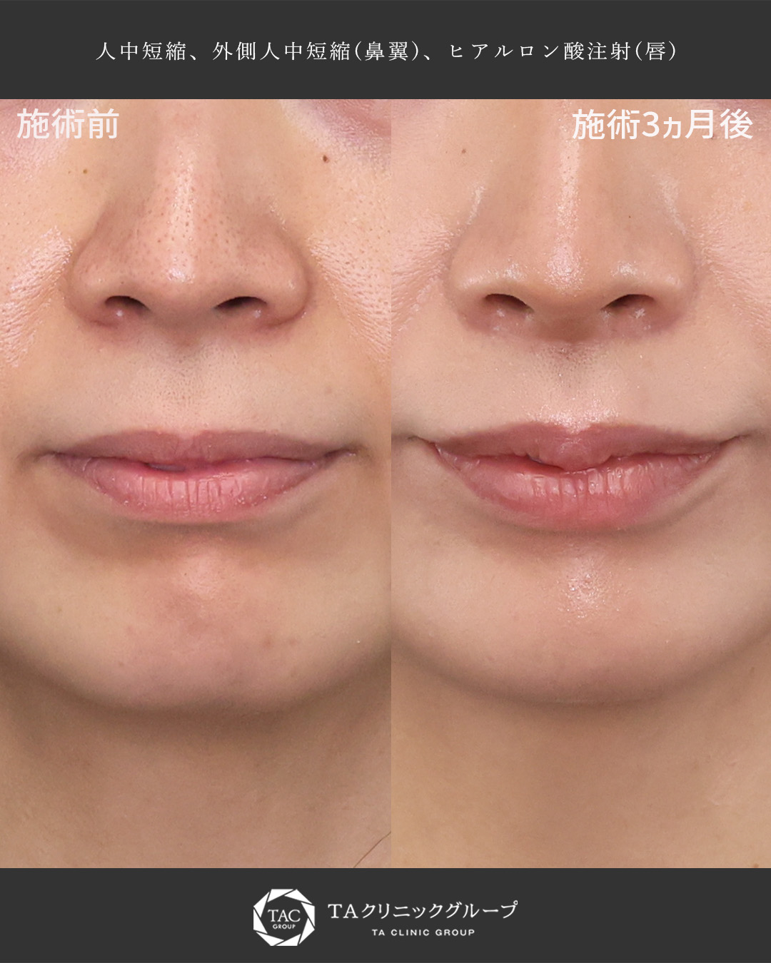 人中短縮術(リップリフト)・外側人中短縮術/ヒアルロン酸注射：その他の症例写真 施術前後 