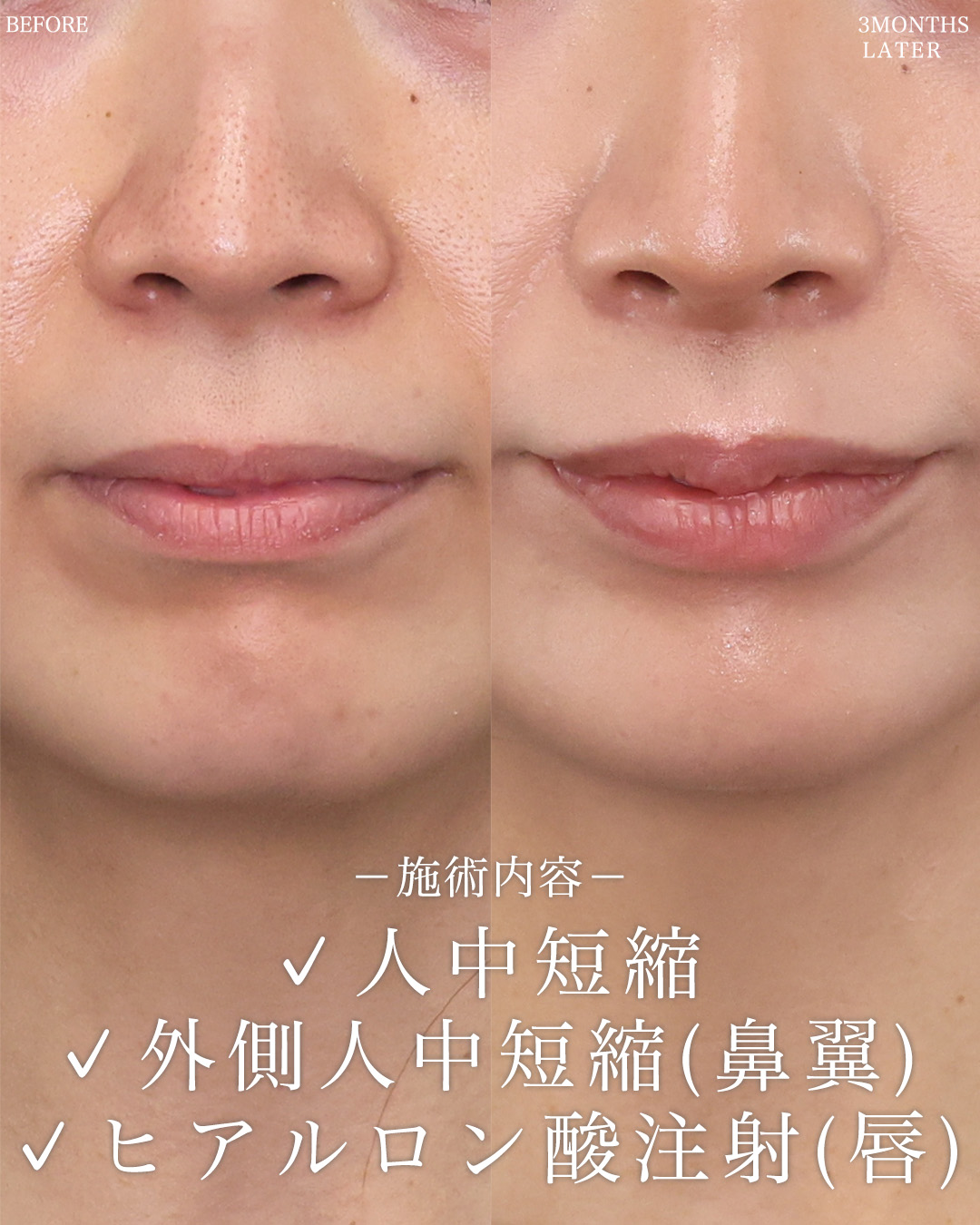 人中短縮術(リップリフト)・外側人中短縮術/ヒアルロン酸注射：その他の症例写真 施術前後 
