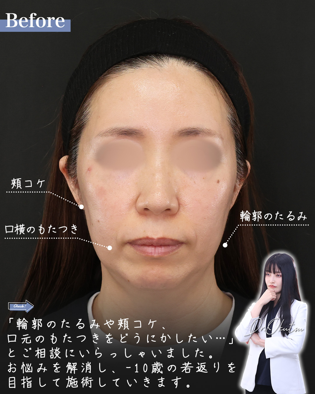 TAC式 ツヤ肌コラーゲンリフト®/TAC式 ショッピングリフト/Lラインファット除去（エラ下脂肪除去）の症例写真 施術前後 