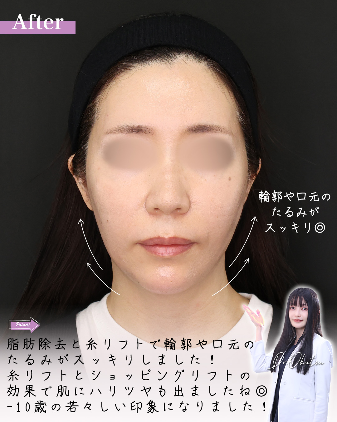 TAC式 ツヤ肌コラーゲンリフト®/TAC式 ショッピングリフト/Lラインファット除去（エラ下脂肪除去）の症例写真 施術前後 