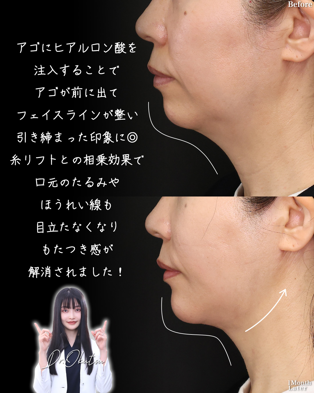 TAC式 ツヤ肌コラーゲンリフト®/TAC式 ショッピングリフト/Lラインファット除去（エラ下脂肪除去）の症例写真 施術前後 