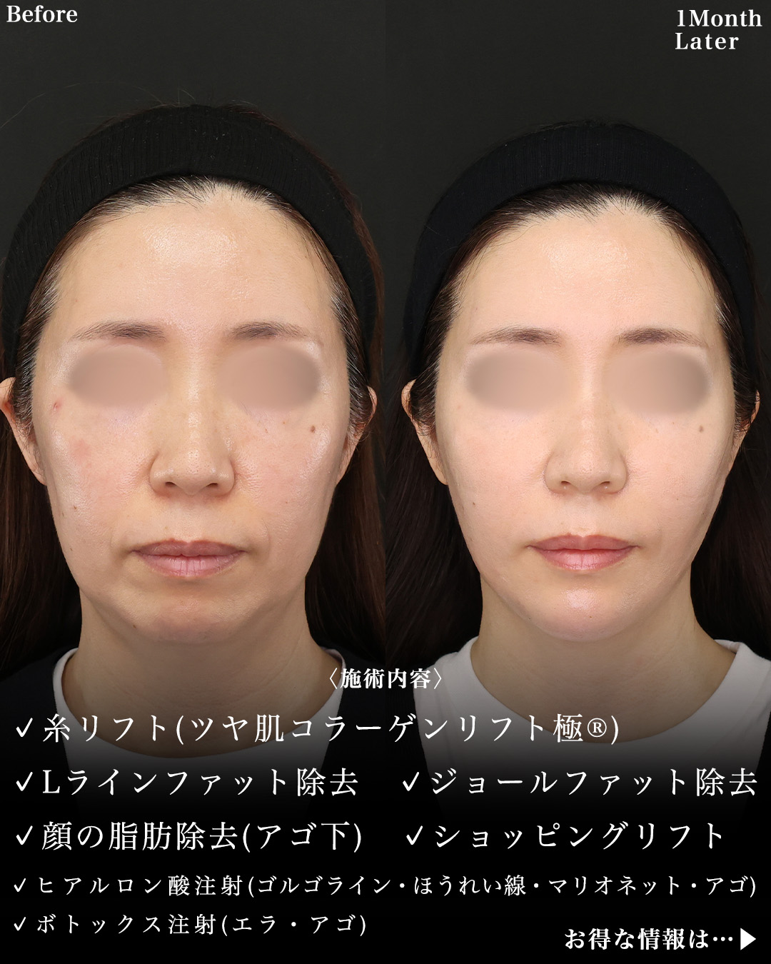 TAC式 ツヤ肌コラーゲンリフト®/TAC式 ショッピングリフト/Lラインファット除去（エラ下脂肪除去）の症例写真 施術前後 