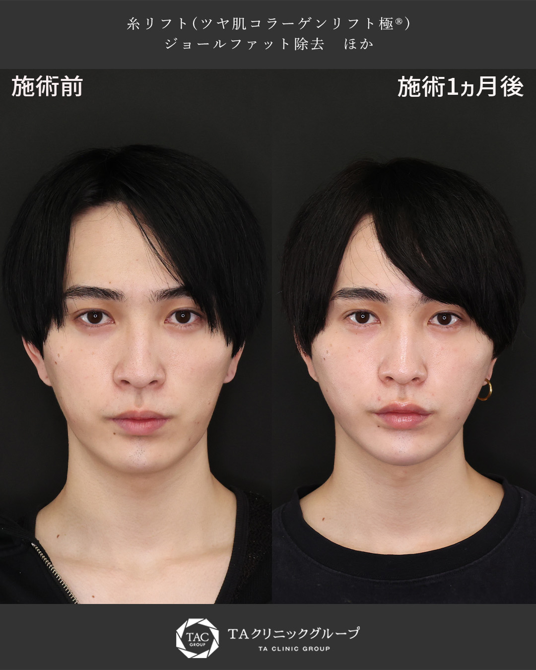 TAC式 ツヤ肌コラーゲンリフト®/ジョールファット除去/おでこ・こめかみのヒアルロン酸注射の症例写真 施術前後 