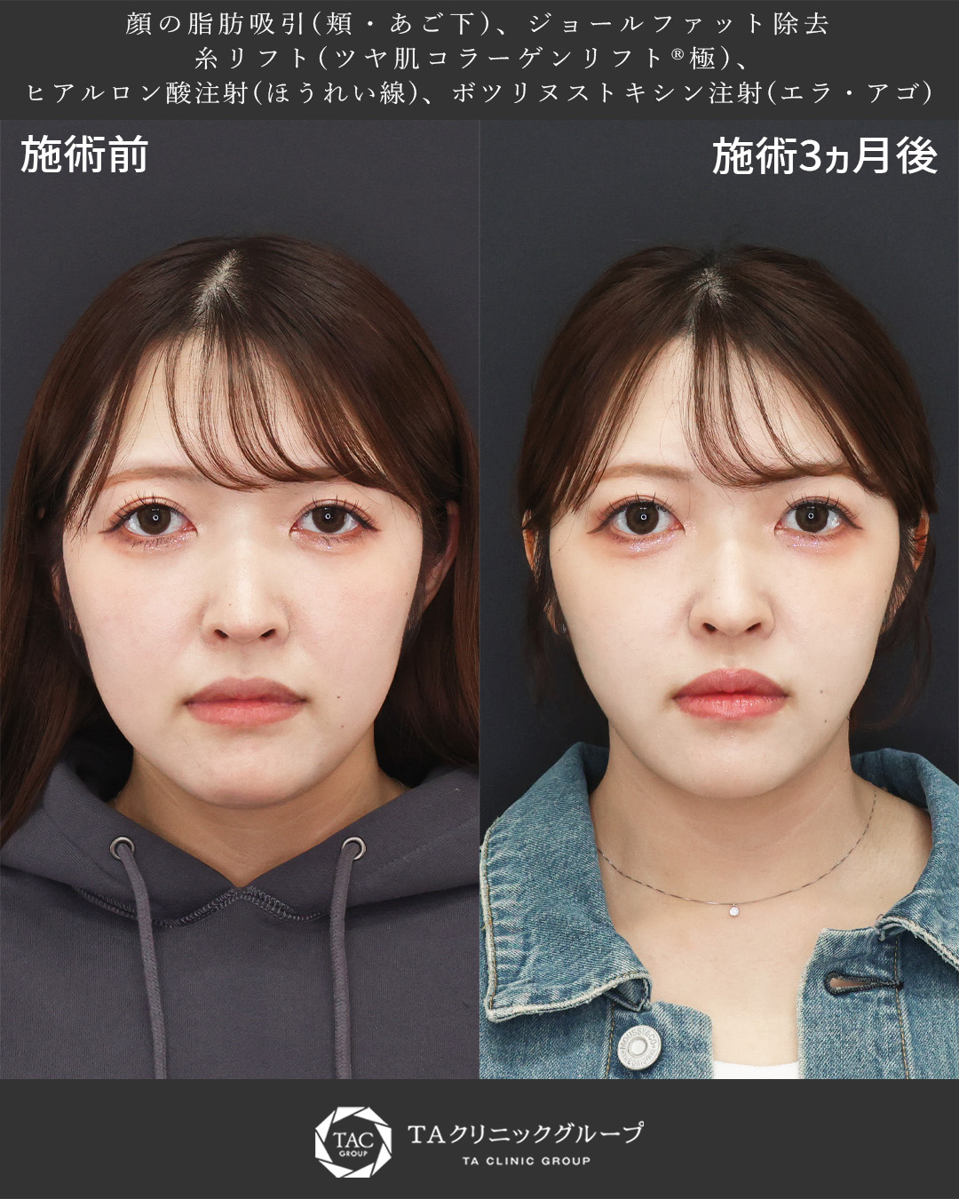 顎下の脂肪吸引/ジョールファット除去/TAC式 ツヤ肌コラーゲンリフト®の症例写真 施術前後 