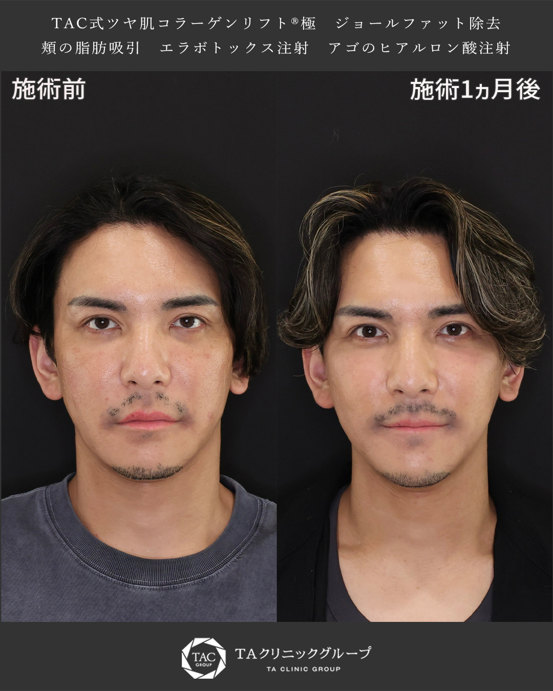 TAC式 ツヤ肌コラーゲンリフト®/ジョールファット除去/顎下の脂肪吸引の症例写真 施術前後 