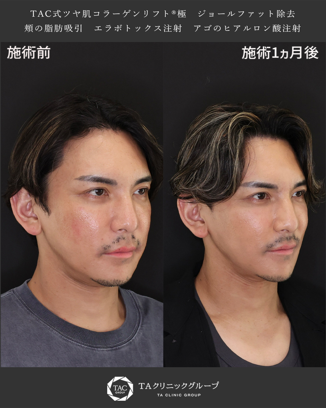 TAC式 ツヤ肌コラーゲンリフト®/ジョールファット除去/顎下の脂肪吸引の症例写真 施術前後 