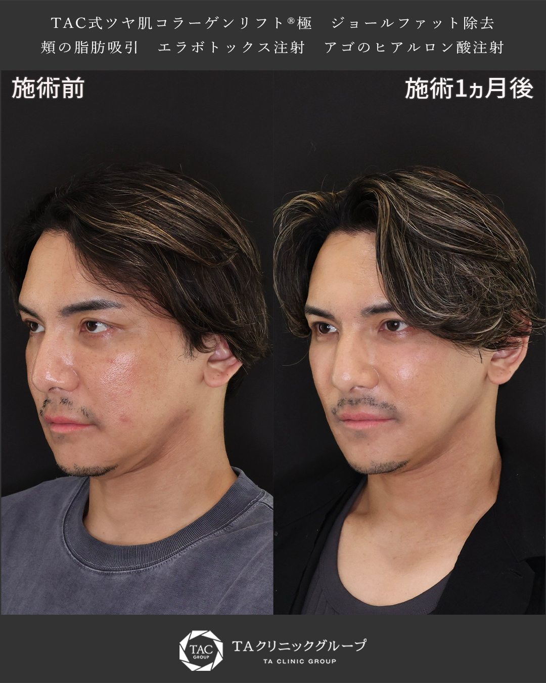 TAC式 ツヤ肌コラーゲンリフト®/ジョールファット除去/顎下の脂肪吸引の症例写真 施術前後 