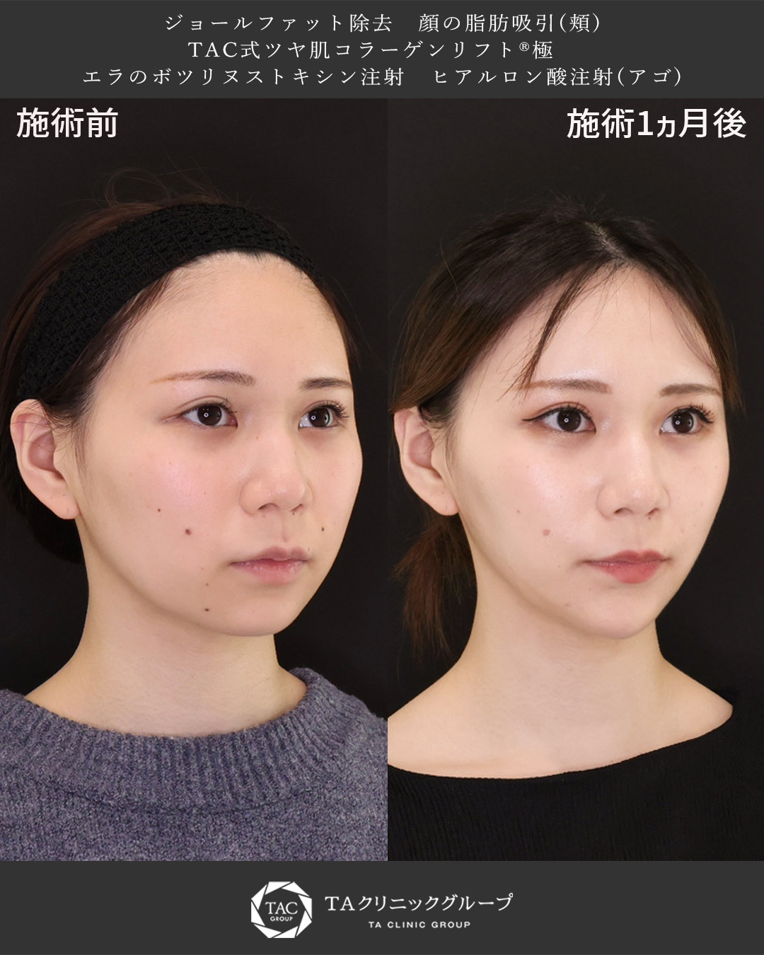 TAC式 ツヤ肌コラーゲンリフト®/ジョールファット除去/顎下の脂肪吸引の症例写真 施術前後 