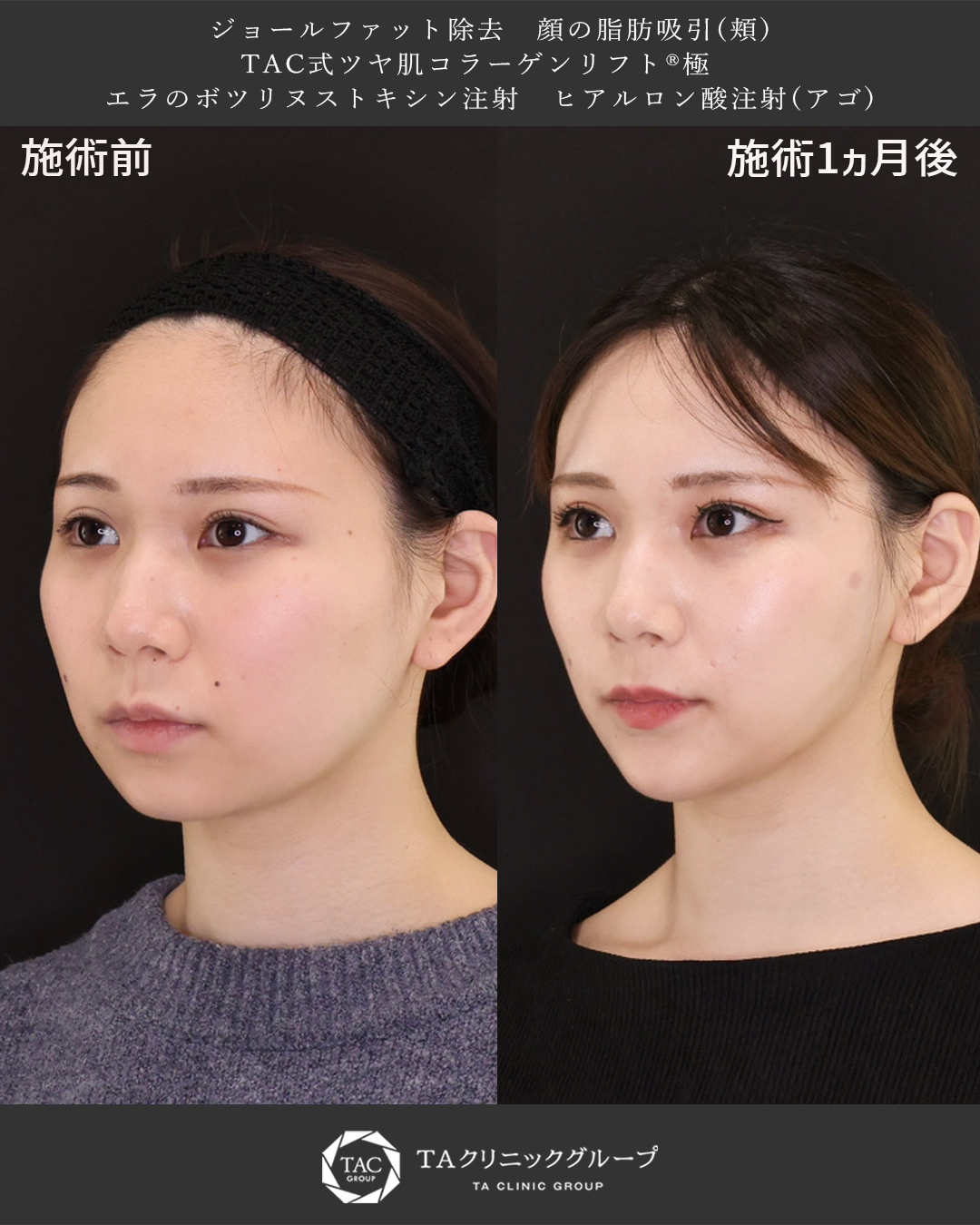 TAC式 ツヤ肌コラーゲンリフト®/ジョールファット除去/顎下の脂肪吸引の症例写真 施術前後 