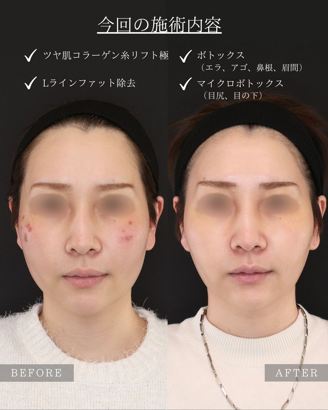TAC式 ツヤ肌コラーゲンリフト®/Lラインファット除去（エラ下脂肪除去）/ボトックス注射：その他の症例写真 施術前後 