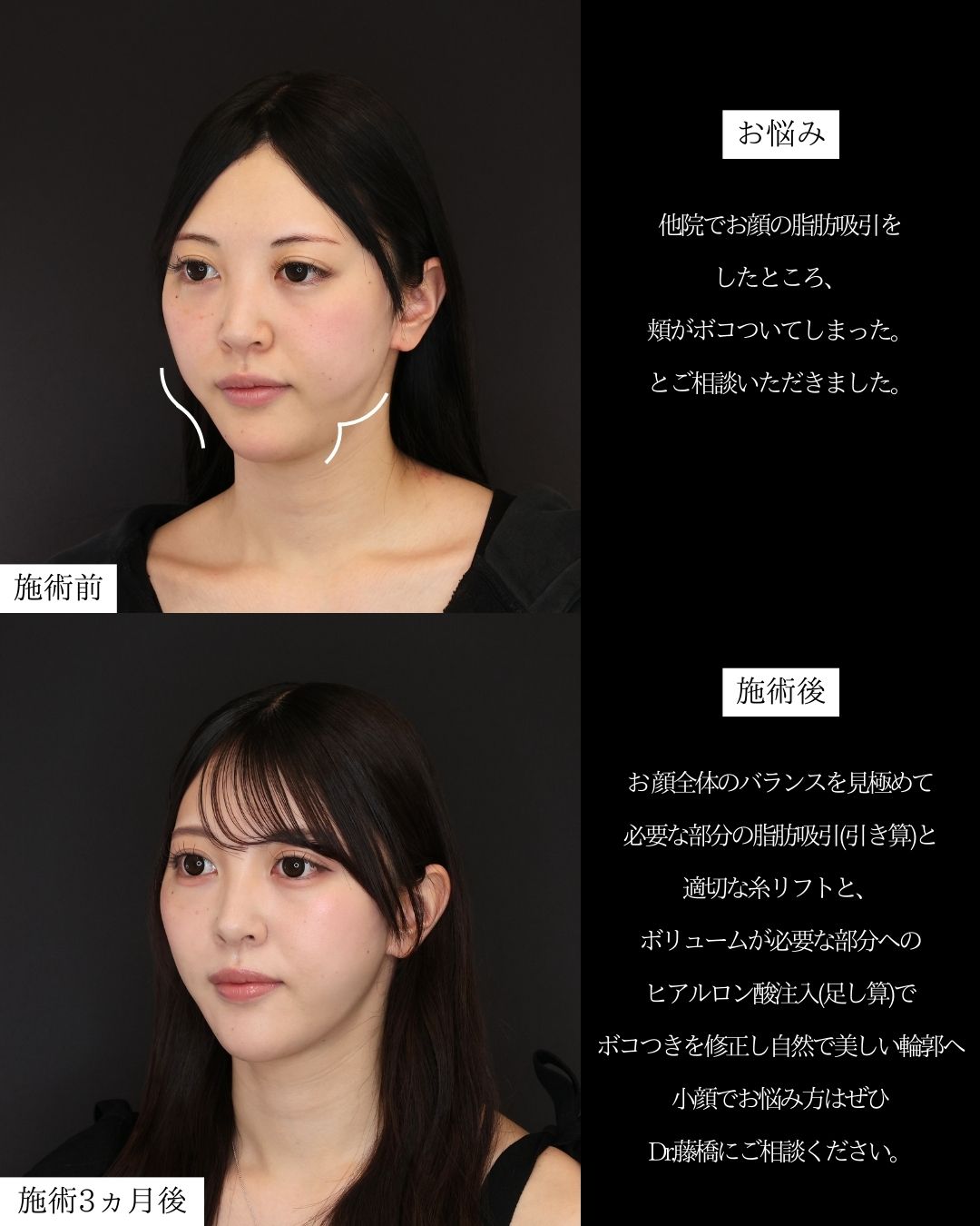 TAC式 ツヤ肌コラーゲンリフト®/バッカルファット除去/顎下の脂肪吸引の症例写真 施術前後 