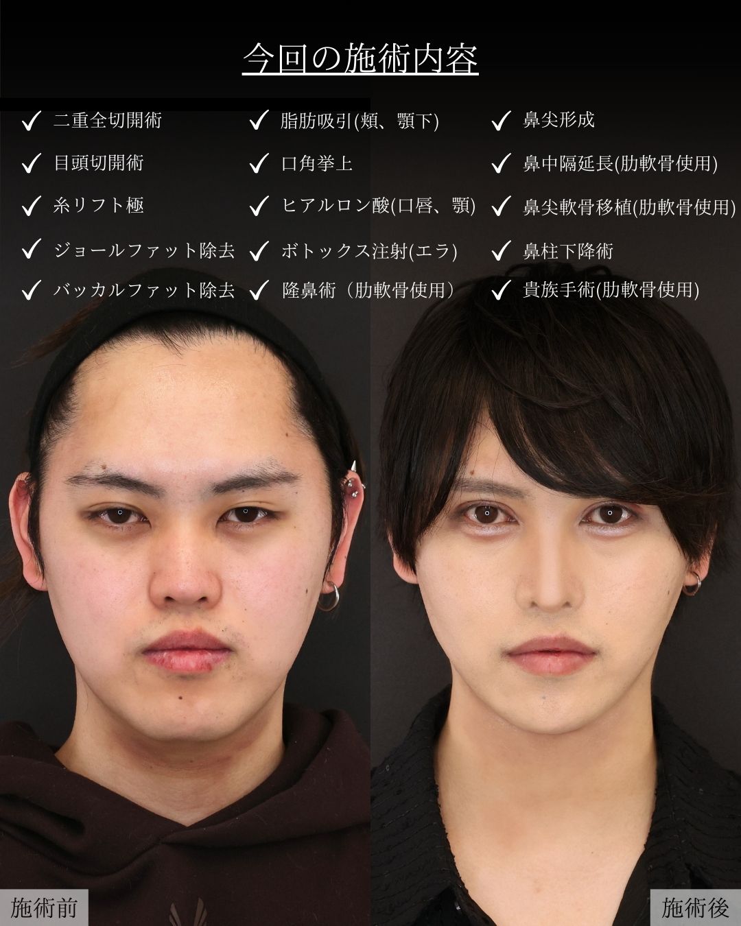 二重切開（全切開法）/目頭切開術/TAC式 ツヤ肌コラーゲンリフト®の症例写真 施術前後 