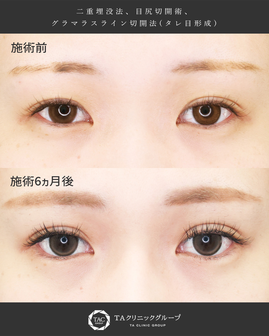 二重埋没法/グラマラスライン（タレ目形成）/目尻切開術の症例写真 施術前後 
