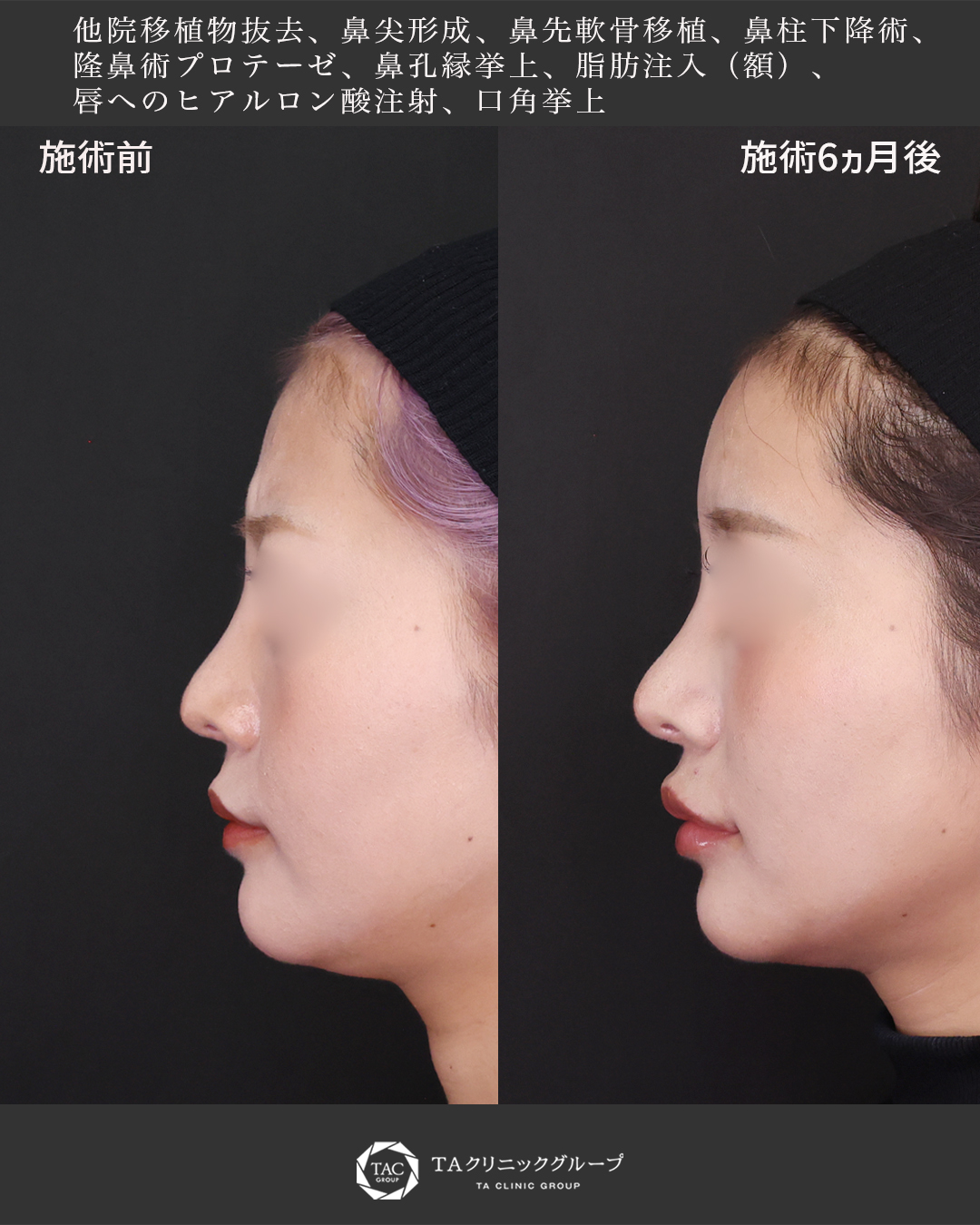 鼻尖形成・鼻尖縮小/鼻先軟骨移植/鼻中隔延長術の症例写真 施術前後 