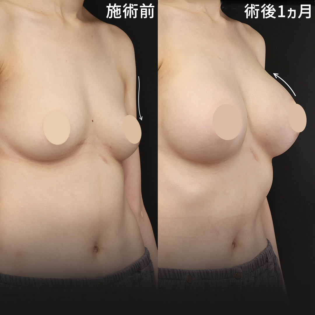 豊胸・バスト：その他/シリコンバッグ豊胸（人工乳腺バッグ）の症例写真 施術前後 