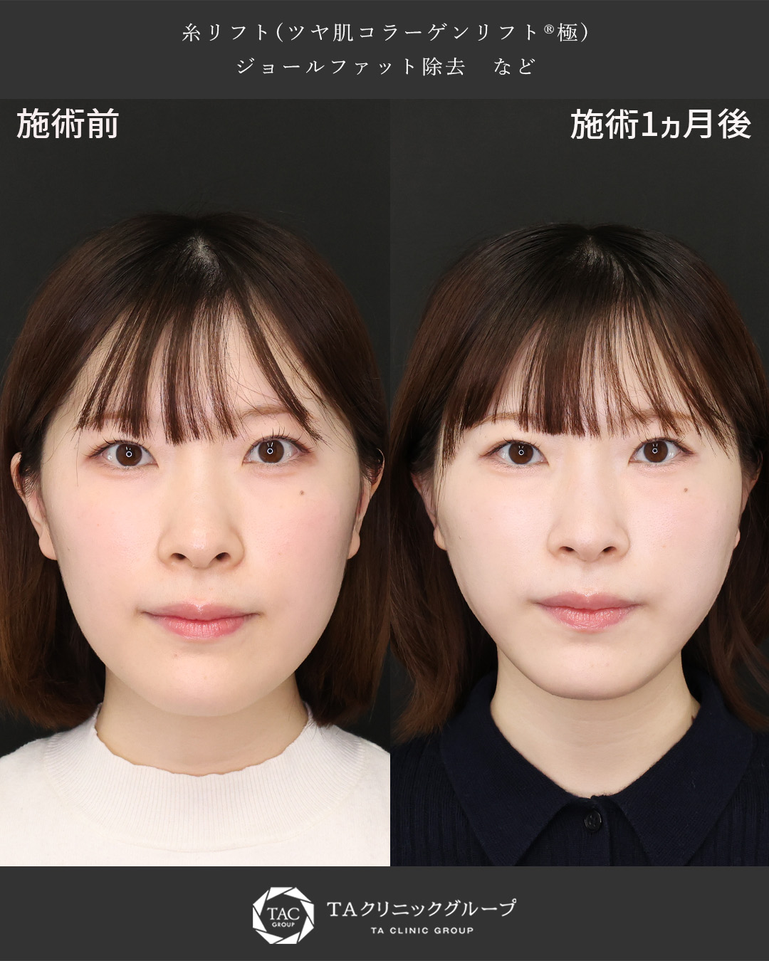 TAC式 ツヤ肌コラーゲンリフト®/ジョールファット除去/マリオネットラインのヒアルロン酸注射の症例写真 施術前後 