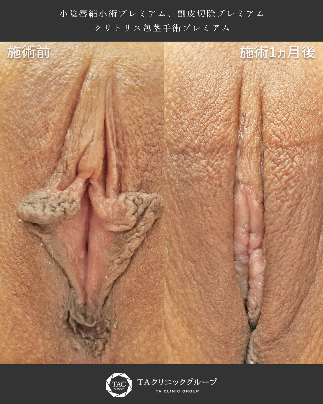 TAC式小陰唇縮小術（ヴィーナスシルエット）/副皮切除/クリトリス包茎手術の症例写真 施術前後 