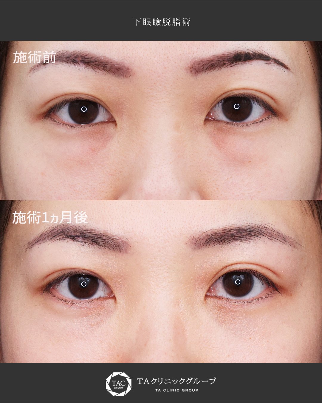 下眼瞼脱脂術（目の下のたるみ取り・目の下の脂肪ふくらみ取り）の症例写真 施術前後 