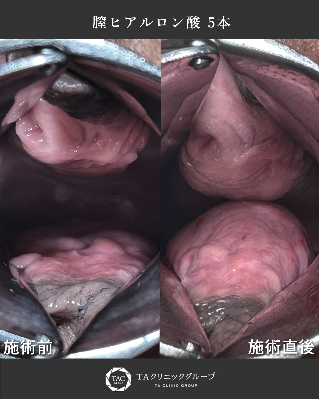 膣縮小術/Gショット不感症改善･膣感度アップ術/膣ハイフ（ヴィーナスハイフ）で膣圧向上の症例写真 施術前後 