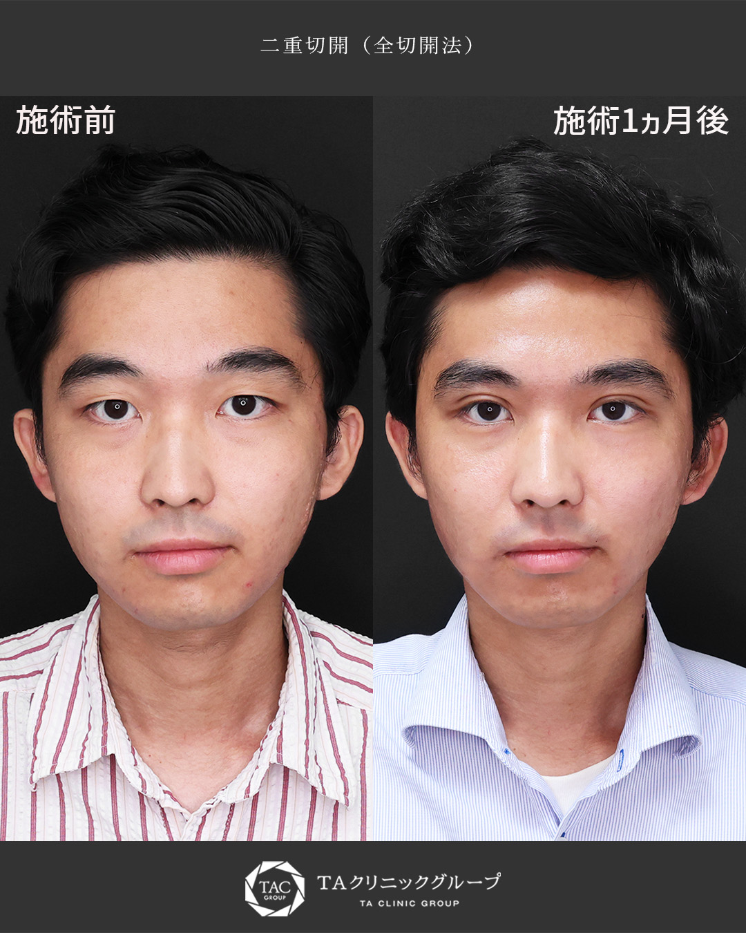 二重切開（全切開法）の症例写真 施術前後 