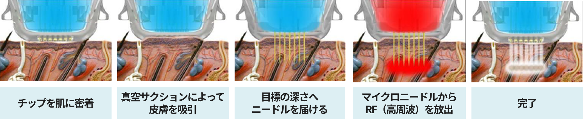 チップを肌に密着 真空サクションによって皮膚を吸引 目標の深さへニードルを届ける マイクロニードルからRFを放出 完了