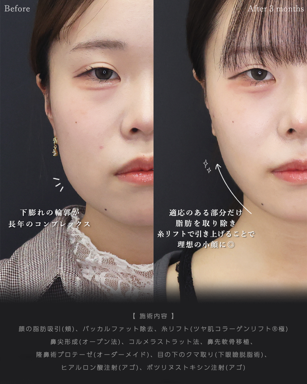 バッカルファット除去/顎下の脂肪吸引/TAC式 ツヤ肌コラーゲンリフト®の症例写真 施術前後 
