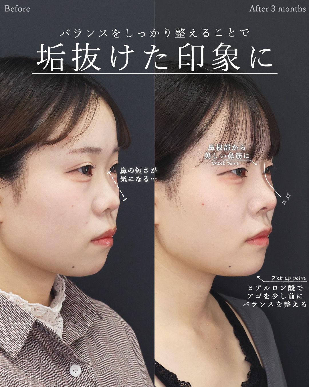 バッカルファット除去/顎下の脂肪吸引/TAC式 ツヤ肌コラーゲンリフト®の症例写真 施術前後 