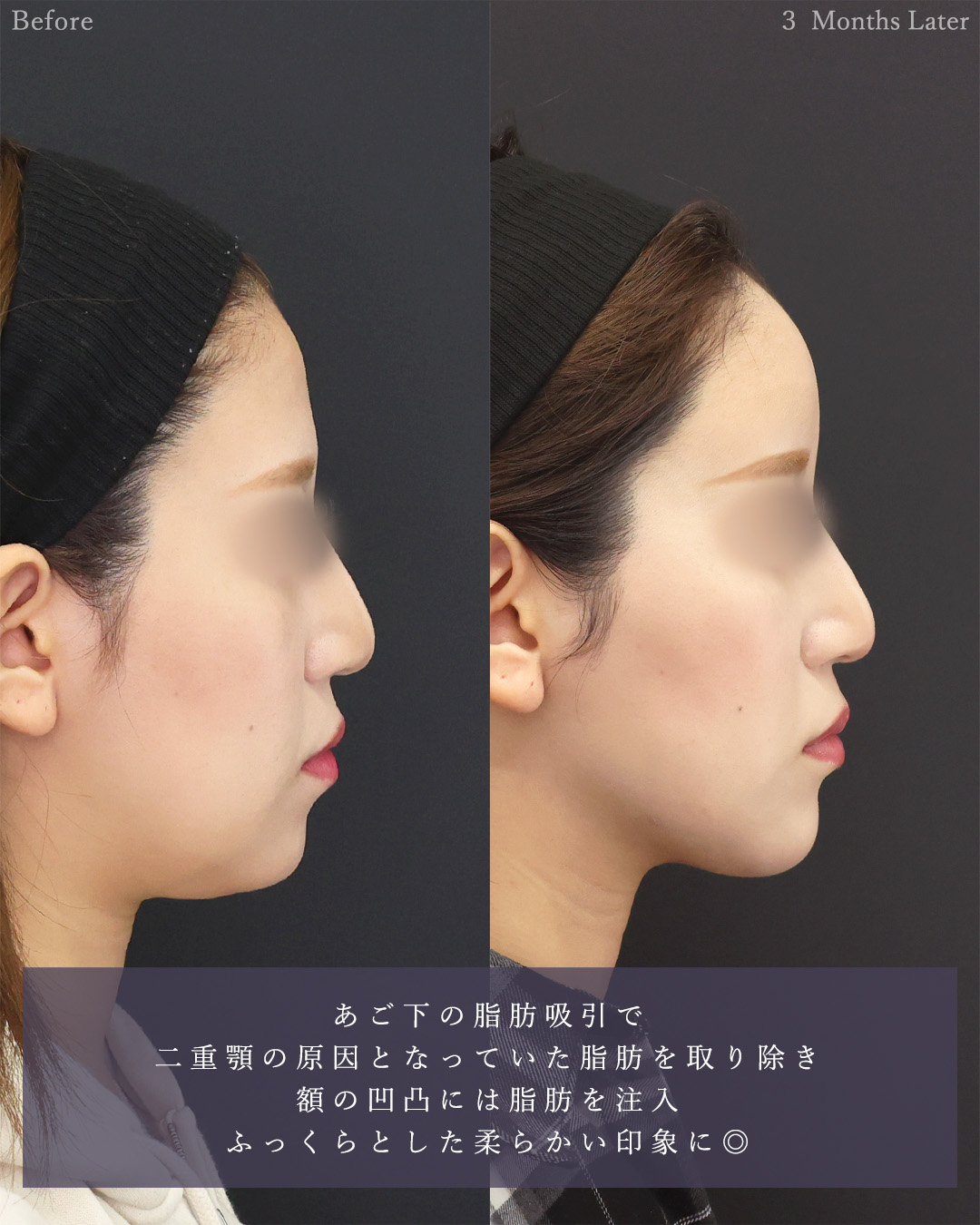 顎下の脂肪吸引/おでこの脂肪注入（オルチャンデコ形成）/ジョールファット除去の症例写真 施術前後 