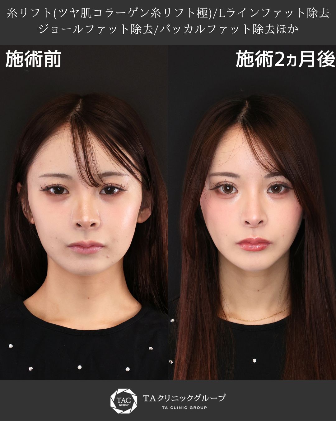 TAC式 ツヤ肌コラーゲンリフト®/ジョールファット除去/バッカルファット除去の症例写真 施術前後 