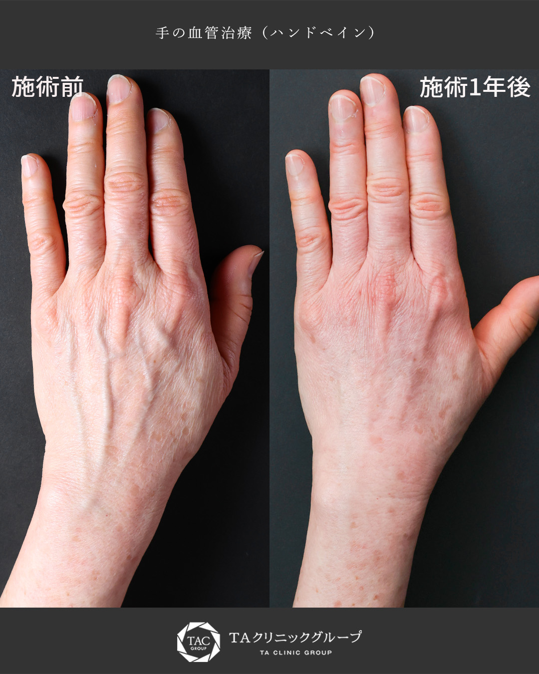 ハンドベイン（手のアンチエイジング・血管治療）の症例写真 施術前後 