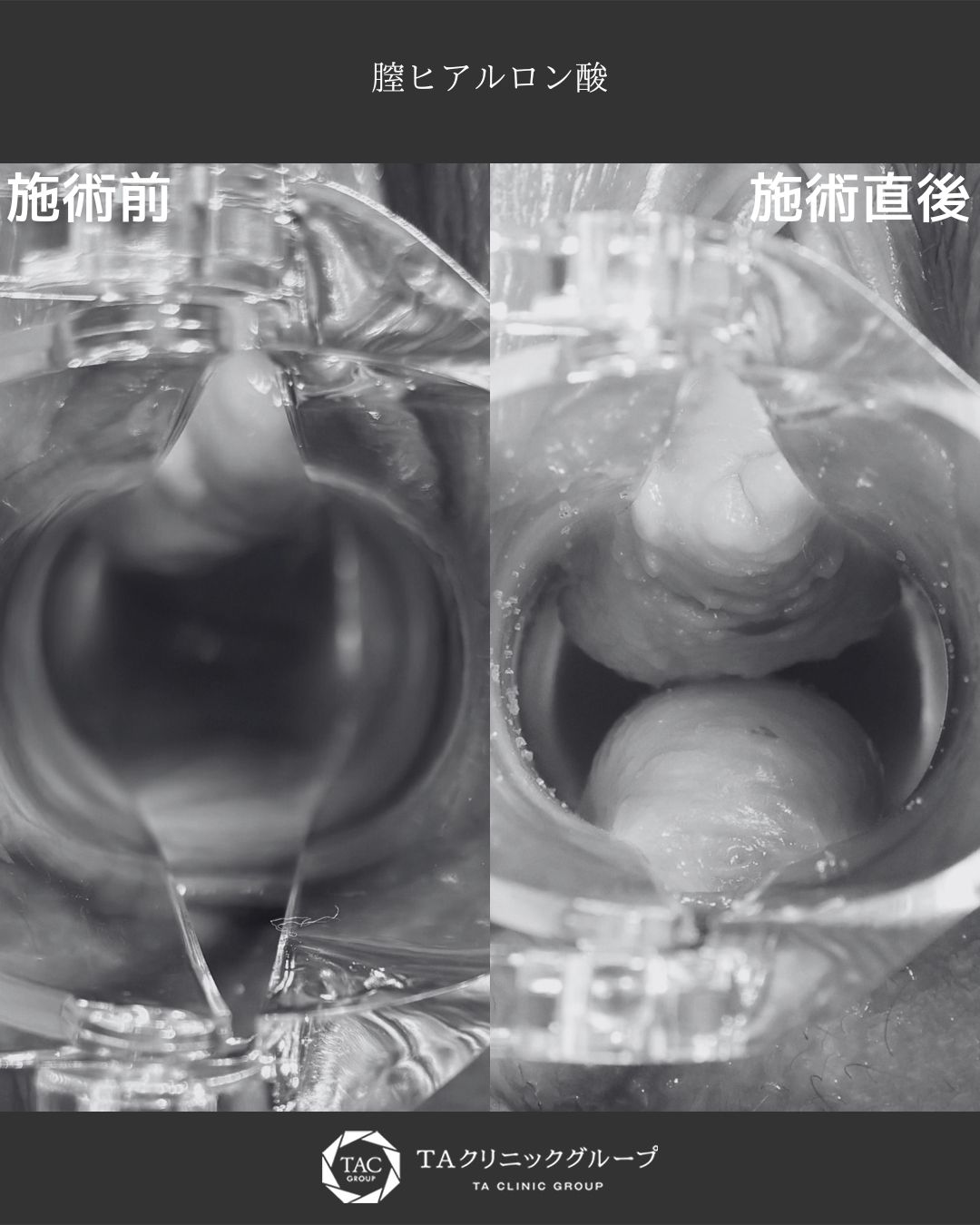 膣ハイフ（ヴィーナスハイフ）で膣圧向上/膣縮小術の症例写真 施術前後 