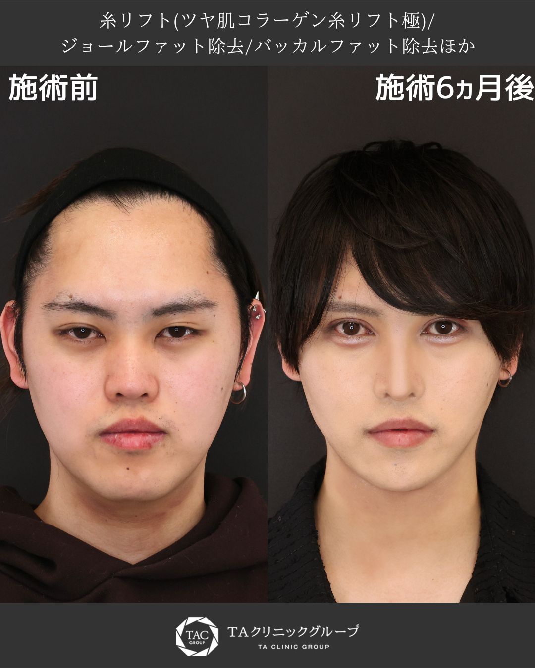 二重切開（全切開法）/目頭切開術/TAC式 ツヤ肌コラーゲンリフト®の症例写真 施術前後 