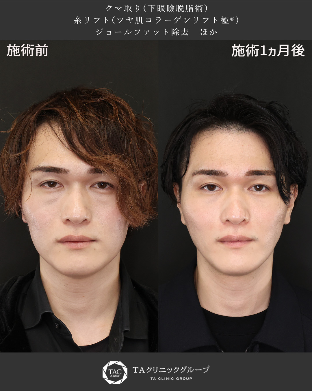 TAC式 ツヤ肌コラーゲンリフト®/ジョールファット除去/下眼瞼脱脂術（目の下のたるみ取り・目の下の脂肪ふくらみ取り）の症例写真 施術前後 