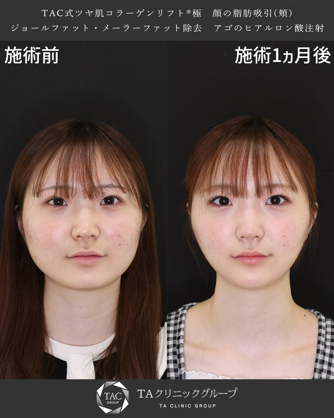 TAC式 ツヤ肌コラーゲンリフト®/顎下の脂肪吸引/顎のヒアルロン酸注射の症例写真 施術前後 