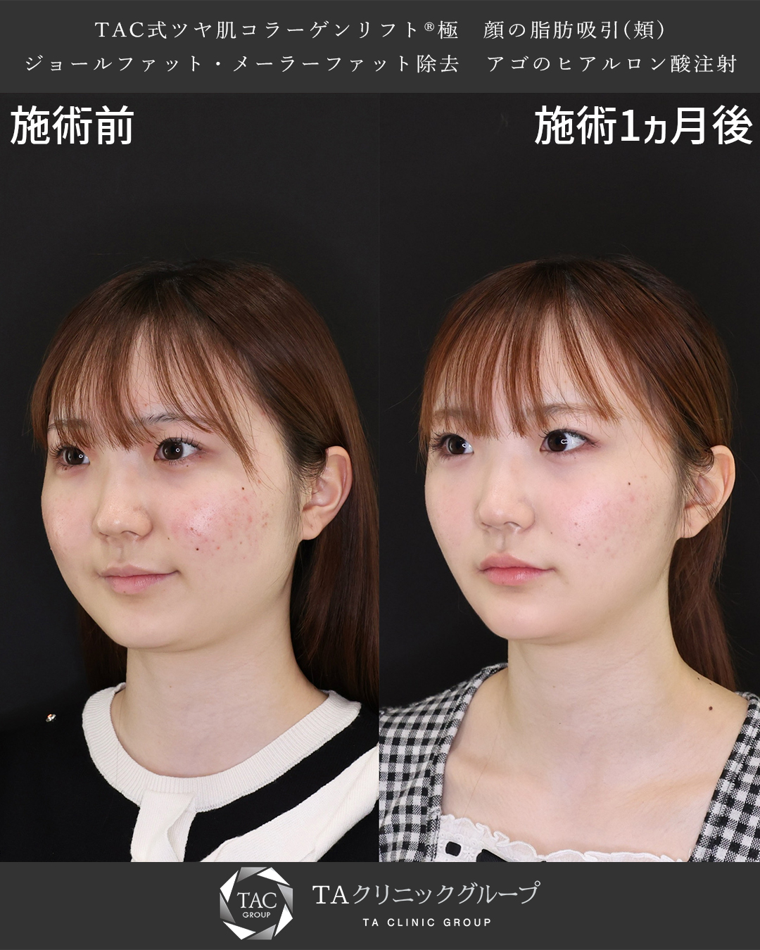 TAC式 ツヤ肌コラーゲンリフト®/顎下の脂肪吸引/顎のヒアルロン酸注射の症例写真 施術前後 