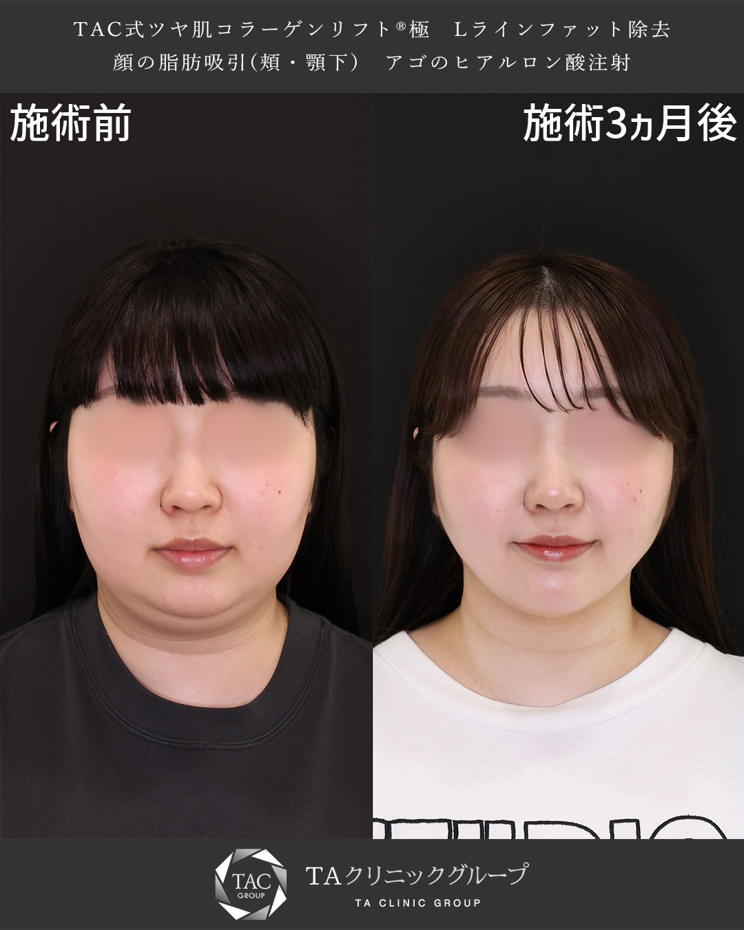 TAC式 ツヤ肌コラーゲンリフト®/顎下の脂肪吸引/Lラインファット除去（エラ下脂肪除去）の症例写真 施術前後 